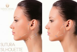 Vantagens fios de sutura absorvíveis Sutura Silhouette dermatologista florianopolis