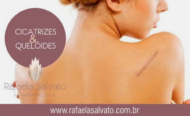 queloide dermatologista florianopolis