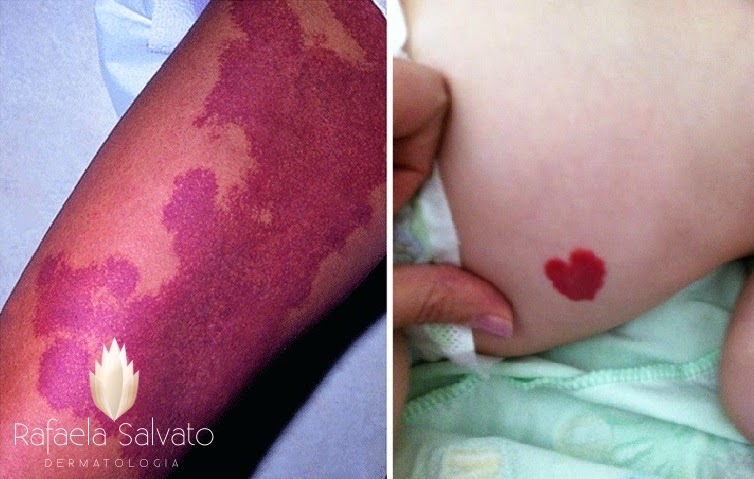tratamento hemangioma blog dermatologista florianopolis