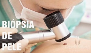 biopsia de pele florianopolis